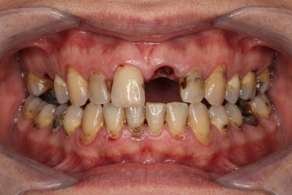 Before: patient with loose lower dentures