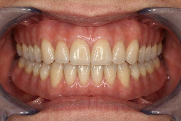 After: implant-retained snap-on denture